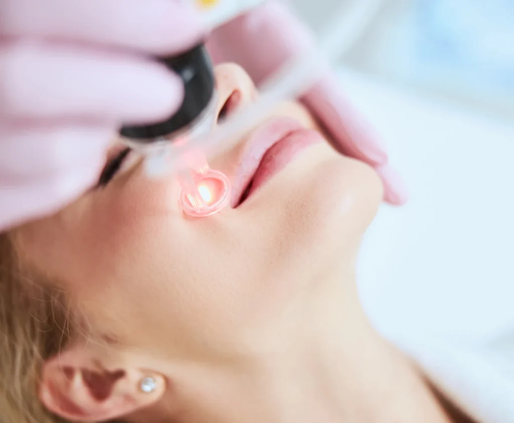 fractional laser