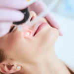 fractional laser